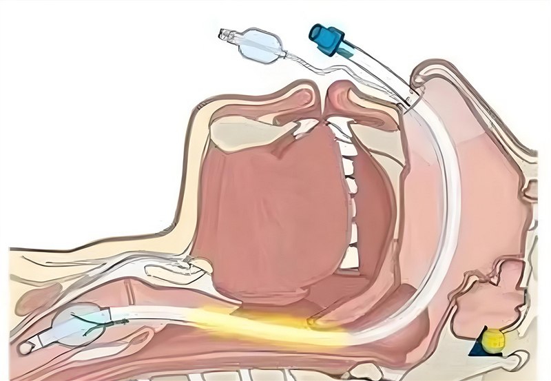 ICU Endotracheal Tube