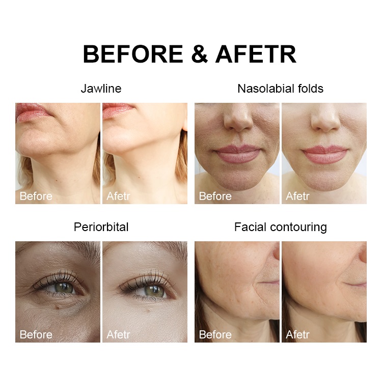 Аппарат для подтяжки лица 7D HIFU, омоложения и омоложения кожи